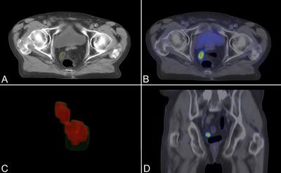 Prostate-specific membrane antigen-based imaging for stereotactic irradiation of low-volume progressive prostate cancer: a single-center experience